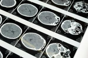 CT scan images of the human brain displayed in a series of black and white panels.